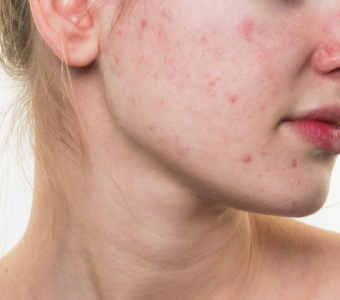 rimedi naturali per l'acne